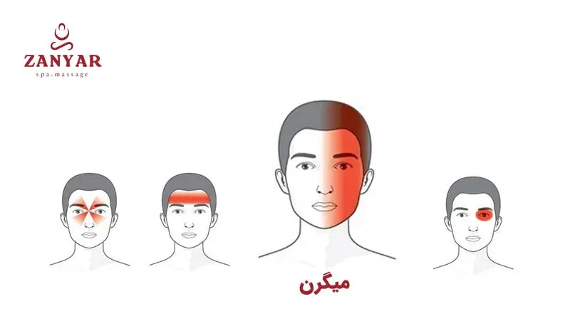 تفاوت میگرن با سردرد معمولی