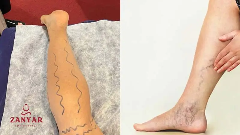 ماساژ برای واریس پا